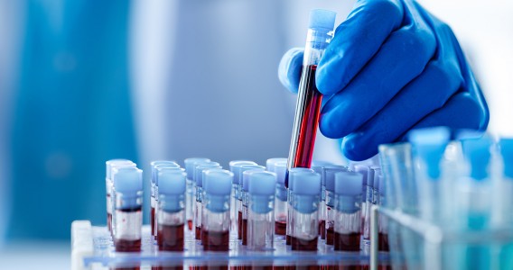 Biorrepositório brasileiro pode ajudar a personalizar a prevenção do câncer no SUS
