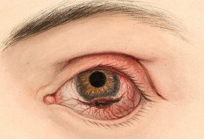 Novo método de terapia fotodinâmica pode erradicar o melanoma ocular, mostra estudo